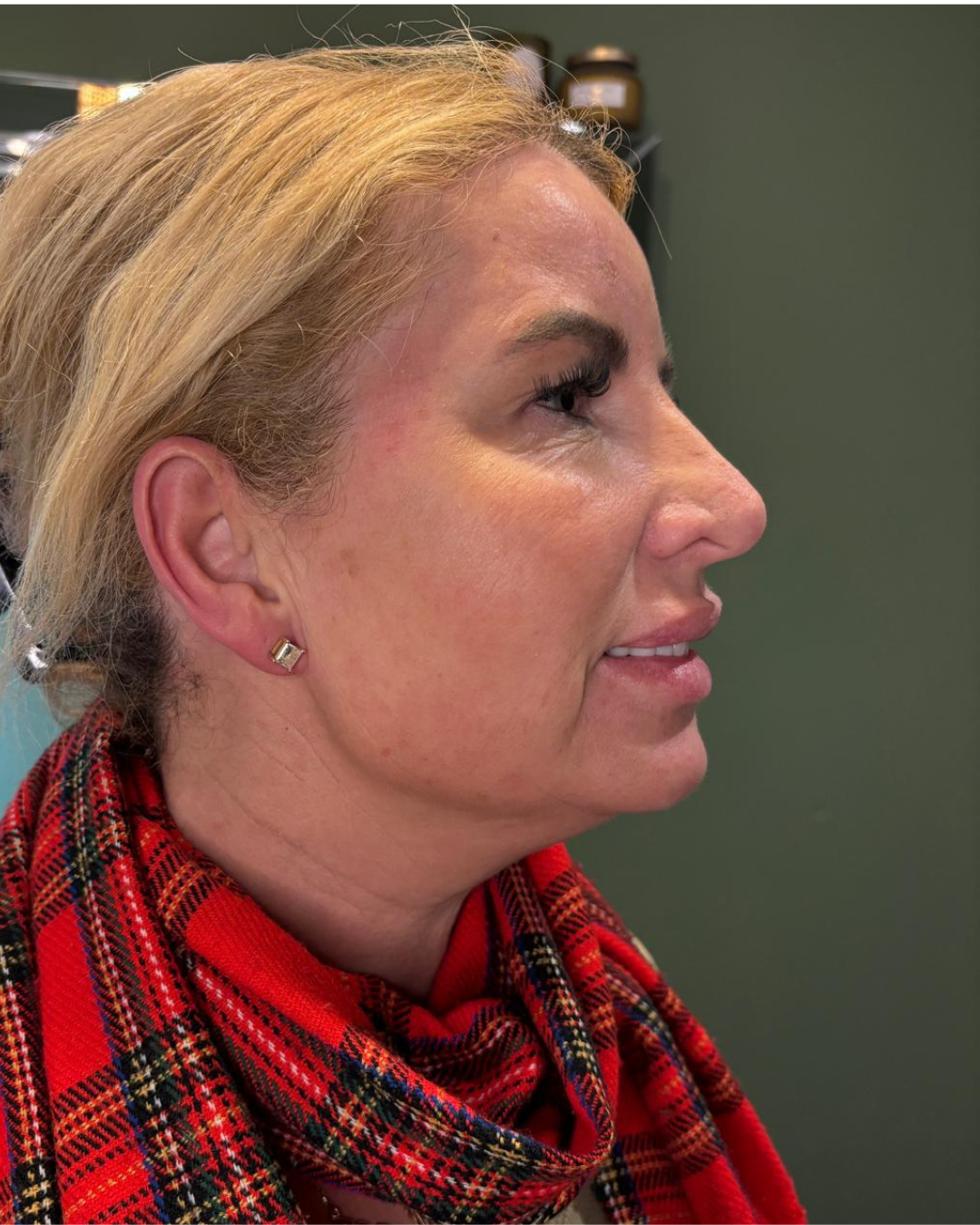 After Nefertiti Lift neck treatment with Botox