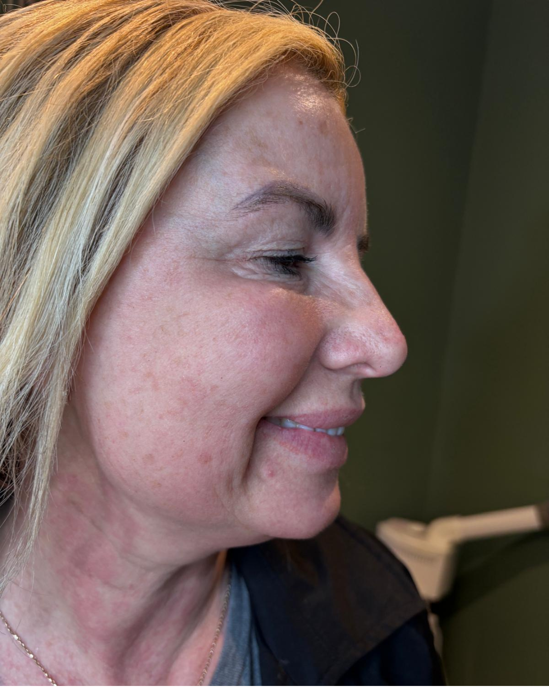 Before Nefertiti Lift neck treatment with Botox