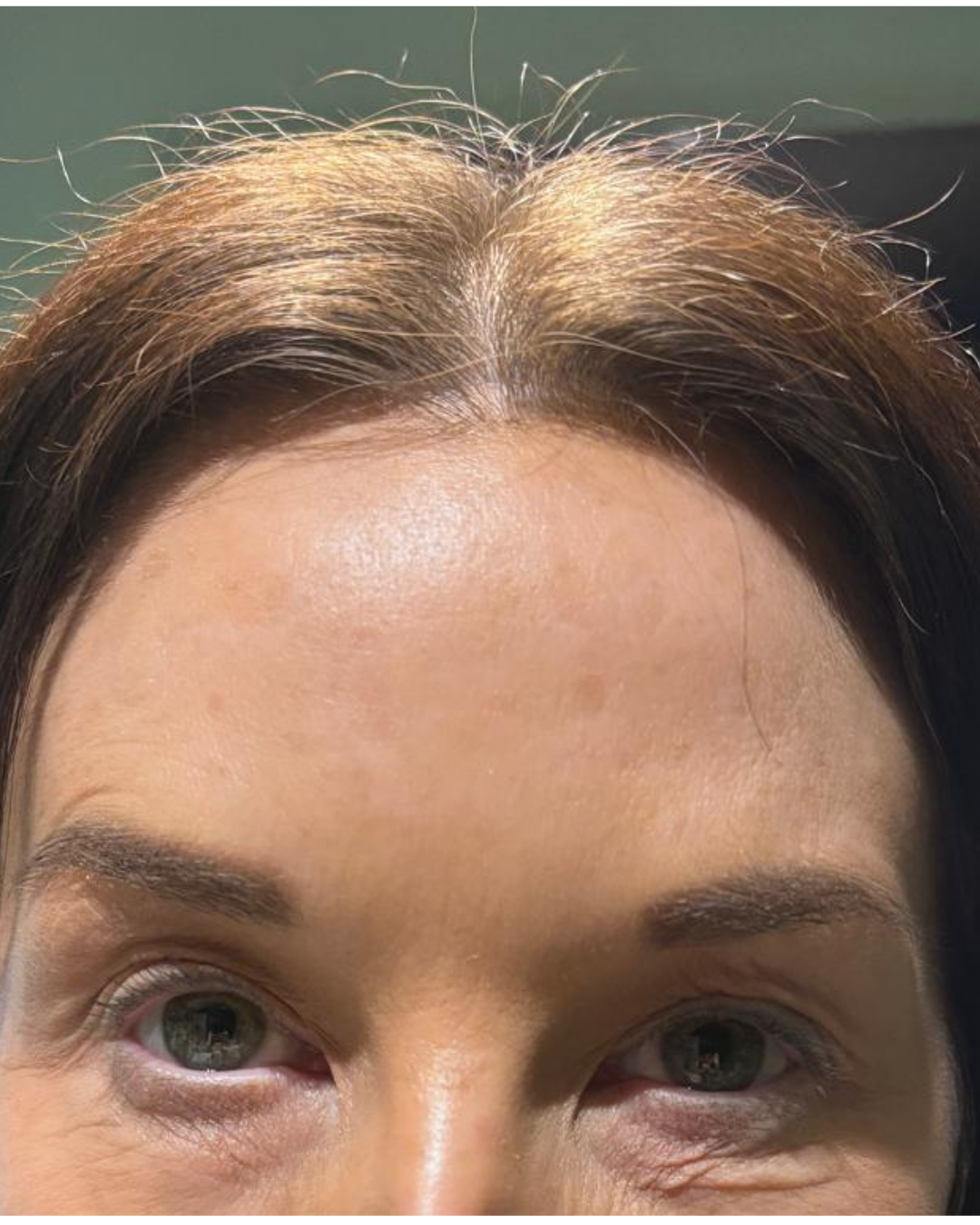 After frown lines reduction with Botox