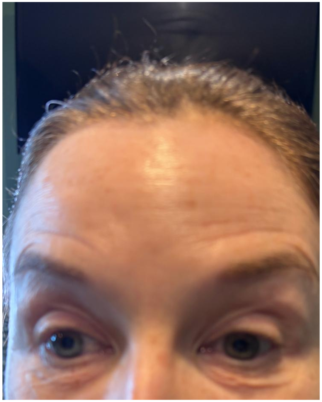 Before frown lines reduction with Botox